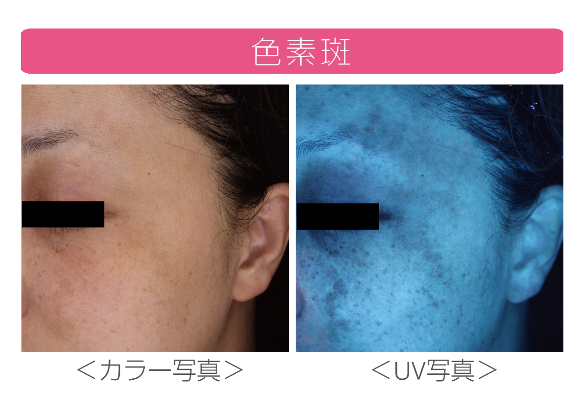 肌診断 Re Beau 交通事故 治療 なかがわ整形 熊本市 整形外科 美容皮膚科