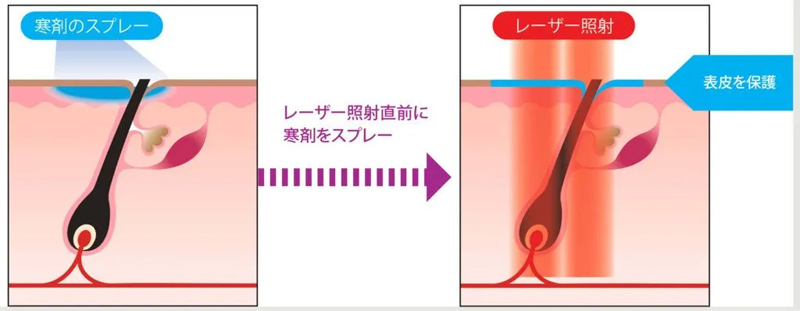 冷却機能の説明図　レーザー照射直前に薬剤をスプレーし、表皮を保護する