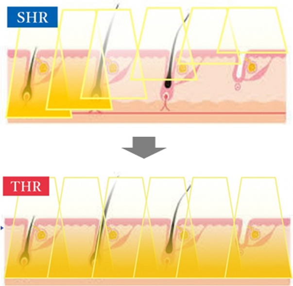 SHRとTHRの違いを表す図　SHRと比較してTHRは光の到達点が広く、成長途中の毛にアプローチしやすい
